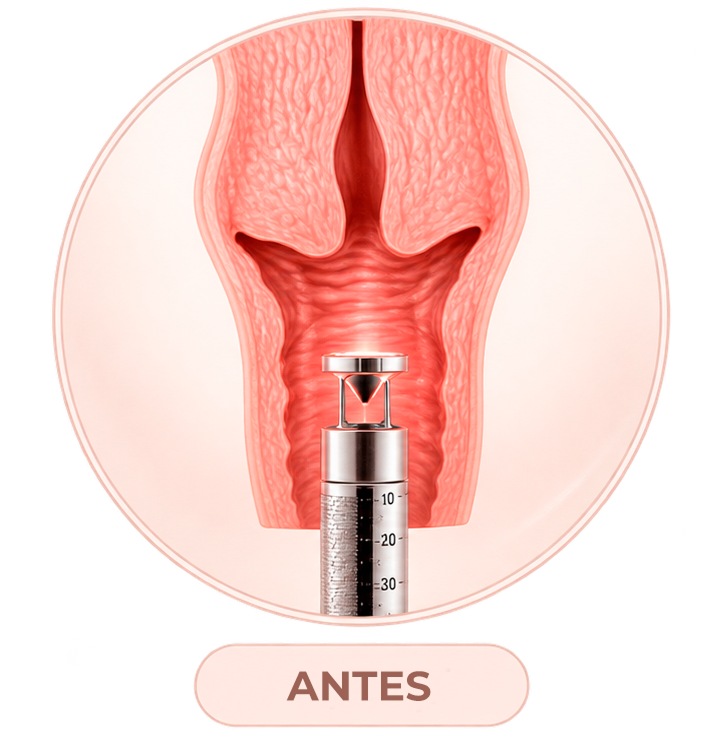 Ilustração da mucosa vaginal antes da aplicação do laser íntimo de CO₂