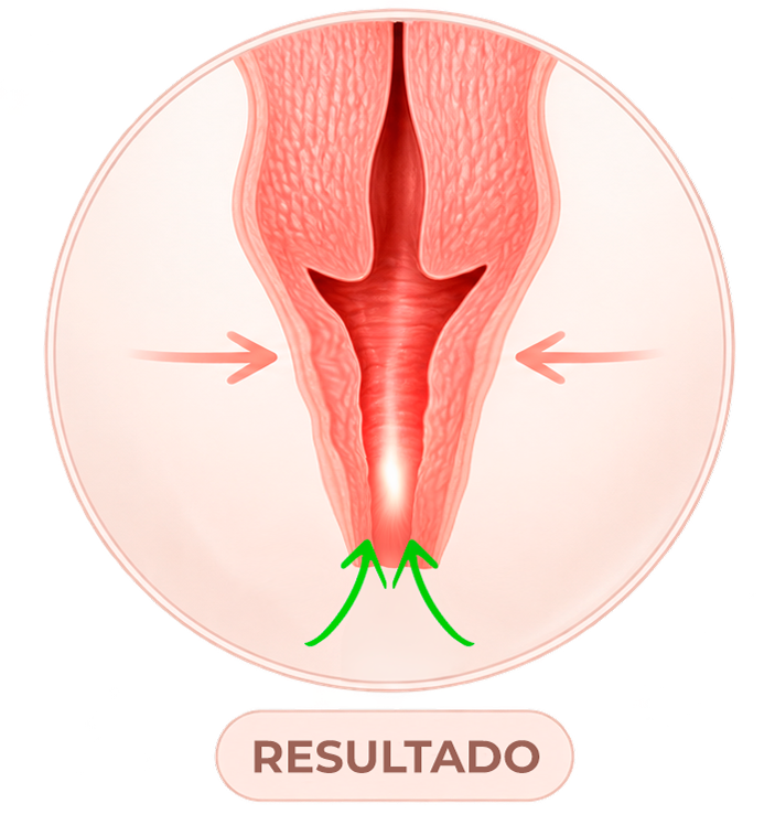 Ilustração do tecido vaginal renovado após o laser íntimo de CO₂